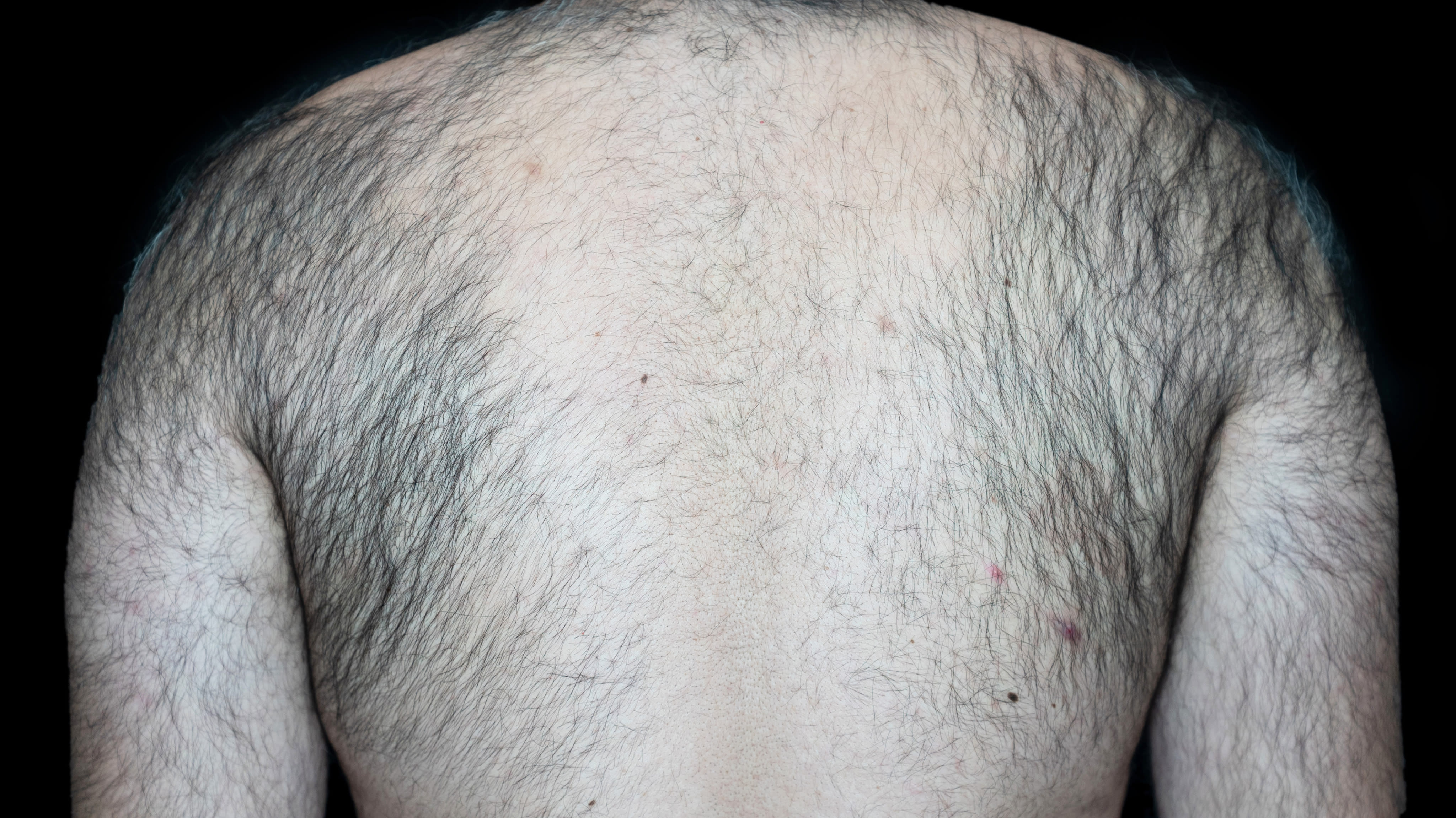 Laser hair removal back before treatment